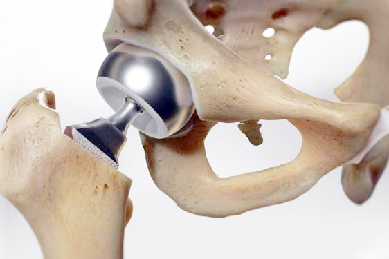 Bipolar Hip Prosthesis