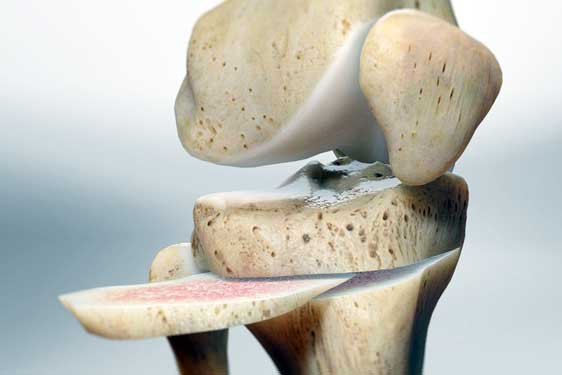 Osteotomy of the Knee