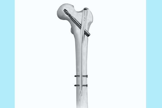 Proximal Femur Nail Antirotation PFNA