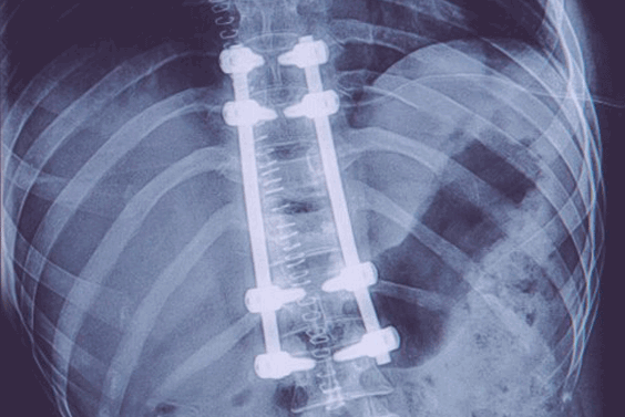 Spinal Implants Manufacturers